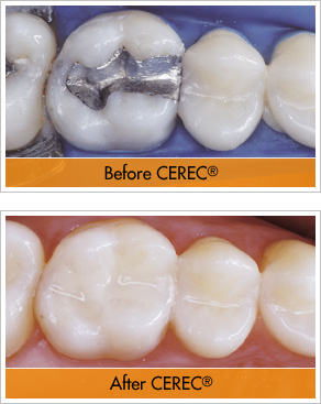 CEREC Knoxville, TN Dean Cosmetic Dentistry