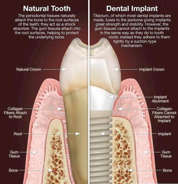 Dental Implant