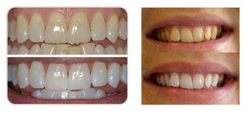 teeth whitening before and after